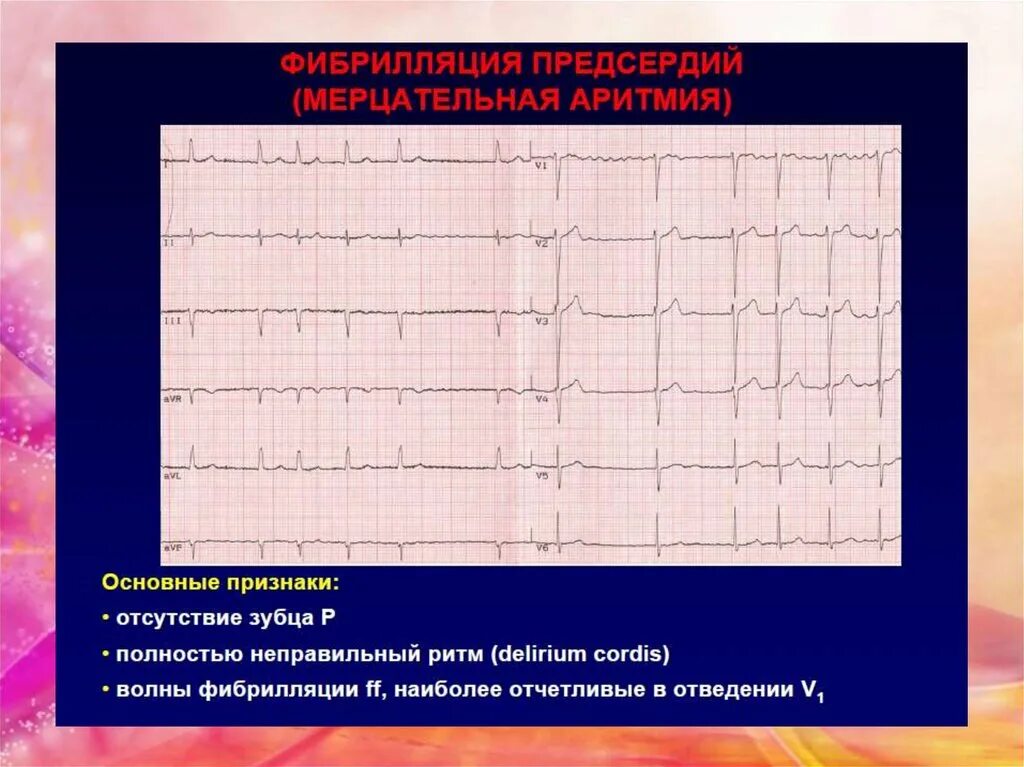Фибрилляция предсердий тахиформа. Трепетание и фибрилляция предсердий на экг. пароксизмальная фибрилляция предсердий на экг. мерцательная аритмия на экг пароксизмальная форма. экг при фибрилляции и трепетании предсердий.