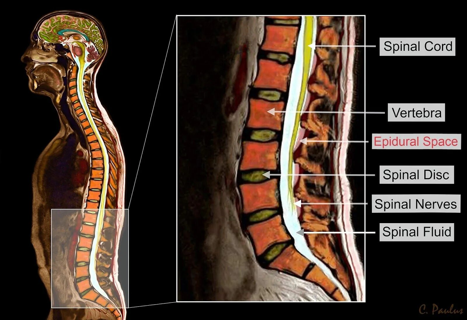 Боль в спинном мозге. Lumbar Spine Anatomy MRI. Spinal. Спинной мозг женщина. Искривление спинного мозга.