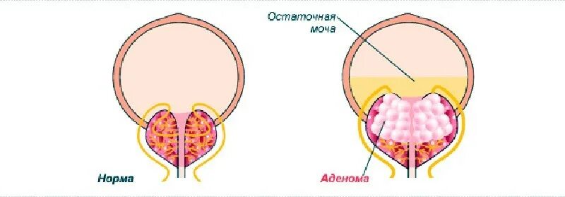 В мочевом остается моча после мочеиспускания. Остаточная моча у женщин норма. Выведение мочи из мочевого пузыря. Моча из мочеточников поступает в:. Мочевой пузырь у женщин.
