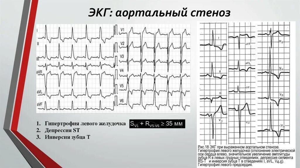 Очаговые изменения левого желудочка. ЭКГ при аортальном пороке сердца. Аортальный стеноз ЭКГ. ЭКГ при стенозе устья аорты. ЭКГ при недостаточности аортального клапана.