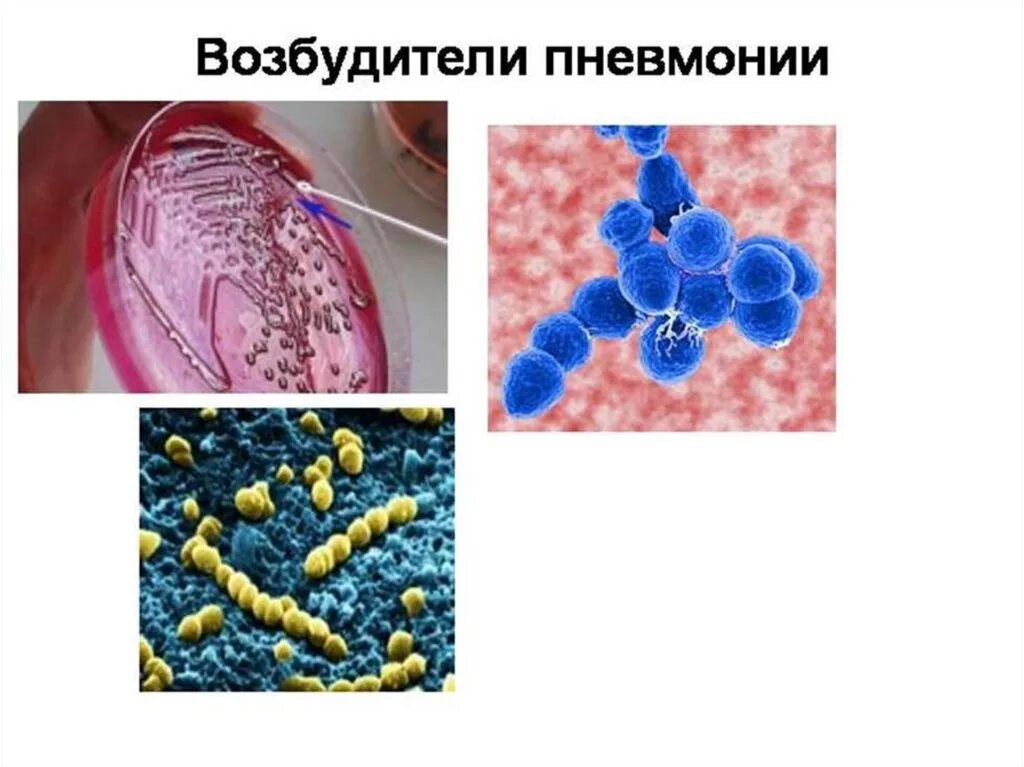 Какие возбудители вызывают пневмонию. Возбудители внебольничной пневмонии. Пневмония возбудитель болезни. Возбудительно внебольничной пневмонии. Возбудитель крупозной пневмонии.