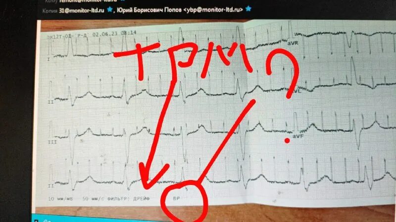 наводка на экг. экг модели. фильтр экг. фильтр экг. фильтр экг.