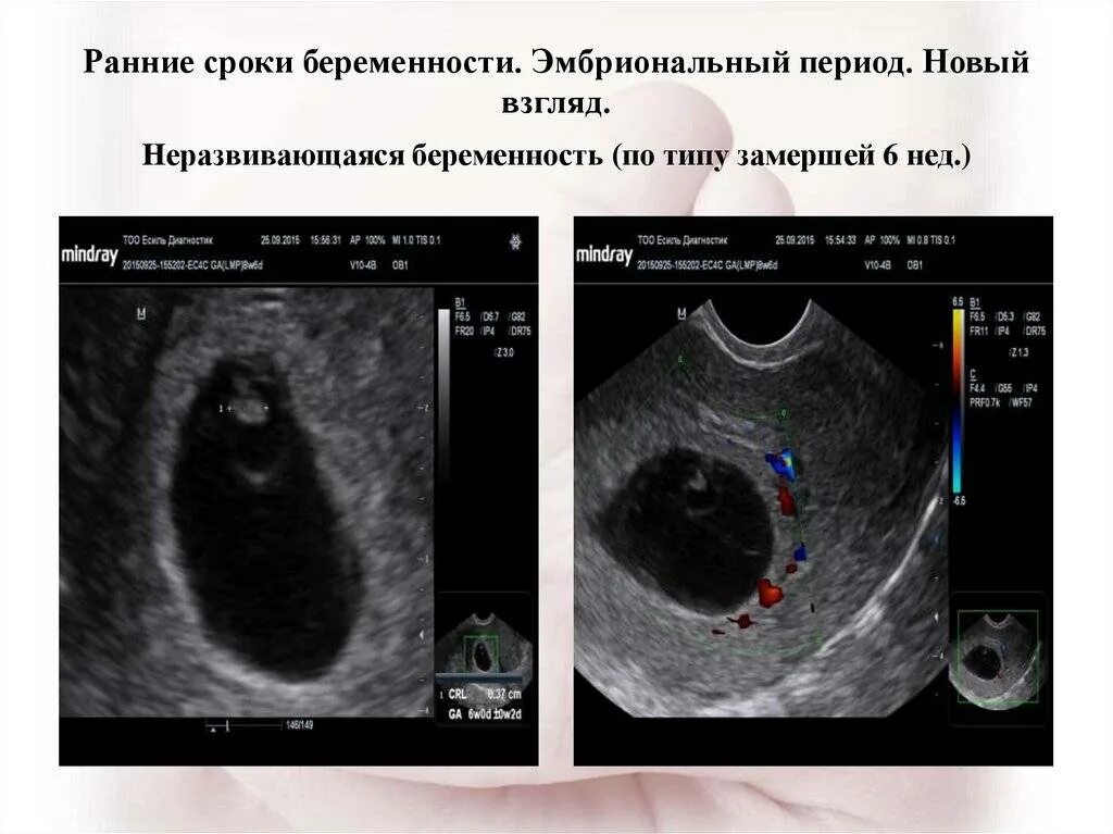 Беременность замершая симптомы признаки на раннем сроке. Неразвивающаяся беременность УЗИ. Неразвивающаяся беременность 7 недель. Неразвивающаяся беременность причины. Замершая беременность УЗИ.