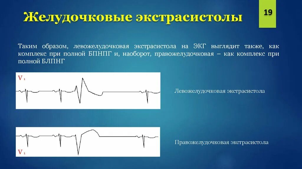 Желудочковая экстрасистолия на ЭКГ. ЭКГ монотопные желудочковые экстрасистолы. Экстрасистолия правого желудочка ЭКГ. Левожелудочковая экстрасистолия на ЭКГ. Экстрасистолы ощущения