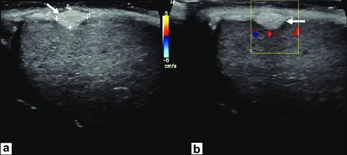 Сонограмма кисты яичка. Киста белочной оболочки УЗИ. Киста белочной оболочки яичка УЗИ. Гиперэхогенные образования яичка.