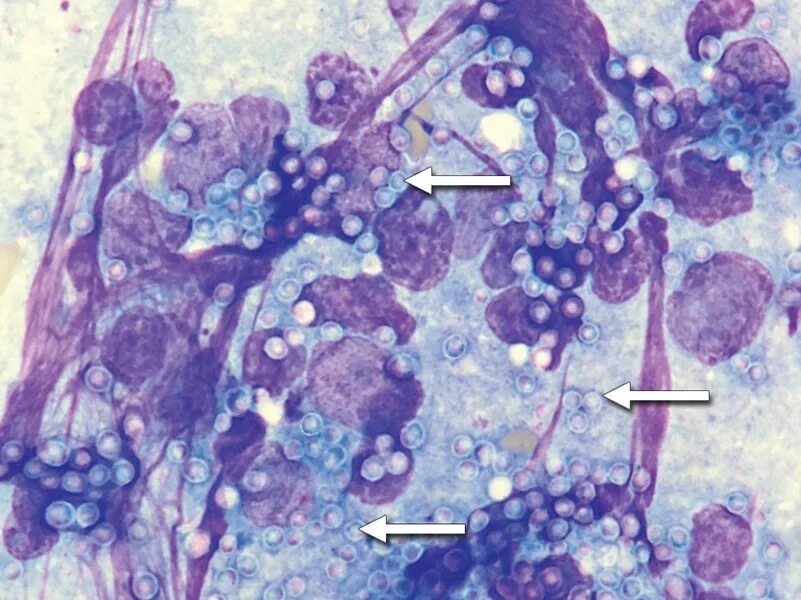 Гистоплазмоз это. Возбудитель гистоплазмоза. histoplasma capsulatum морфология. histoplasma capsulatum микроскопия. гистоплазмоз морфология.