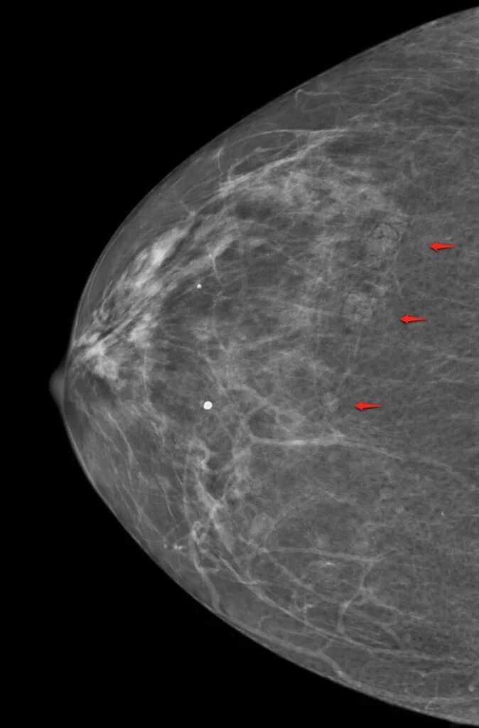 Маммография интрамаммарный узел. Киста на рентгене маммография. Билатеральная маммография. Киста молочной желез маммография. Лимфоузел молочной железы маммография