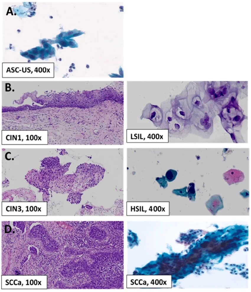 LSIL Cin 1 цитология расшифровка. HSIL цитология расшифровка. Lsil цитология расшифровка что