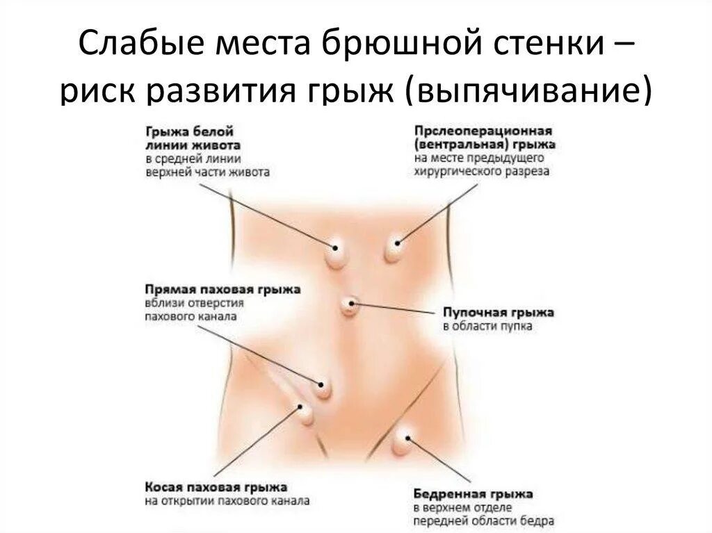 Симптомы грыжи живота у женщин слева