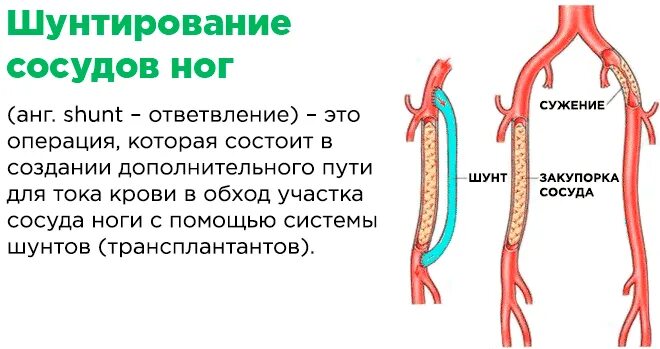 Шунтирование артерий нижних конечностей. Шунтирование при атеросклерозе сосудов. Шунтирование сосудов сердца стент. Шунтирование артерии операция. Хирургическая операция шунтирование сосудов.