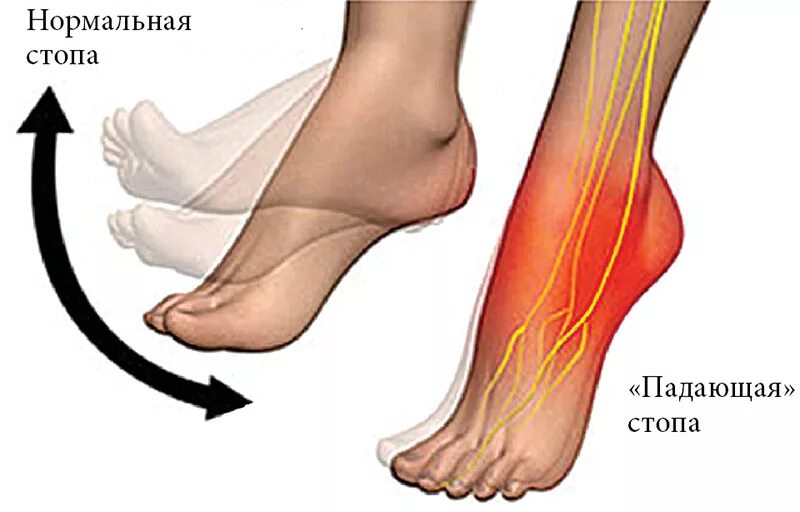 Невропатия стопы. Невропатия малоберцового нерва. Нейропатия малоберцового и большеберцового нерва. Неврит большеберцового нерва. Невропатия (неврит) большеберцового нерва.