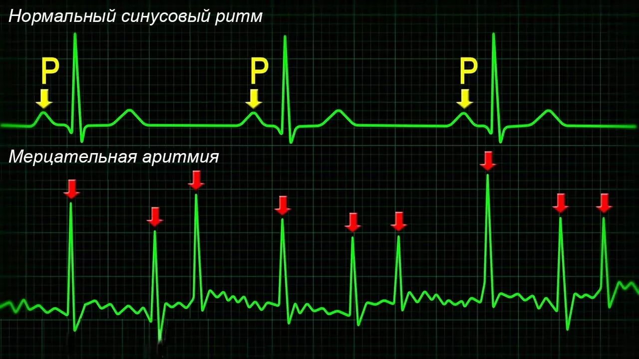 мерцательная ар тмия экн. экг признаки мерцательной аритмии. симптомы фибрилляции предсердий мерцательная аритмия. мерцательная аритмия симптомы. мерцательная аритмия предсердий на экг.