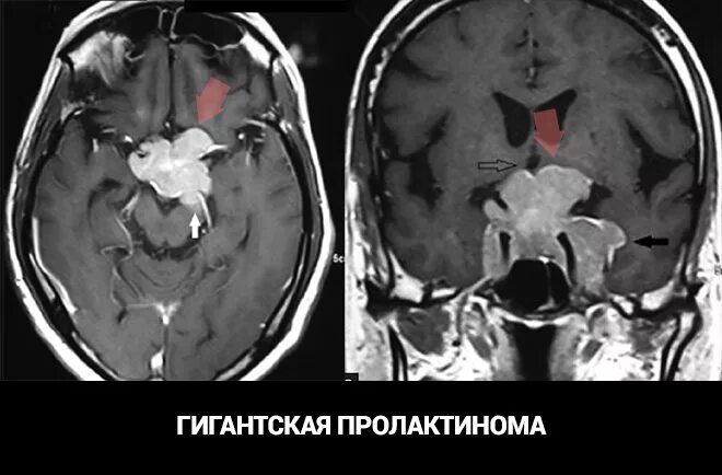 Пролактин микроаденома. Пролактинома гипофиза мрт. Аденома гипофиза мрт. Гиперпролактинемия гипофиз. Микропролактинома гипофиза на мрт.