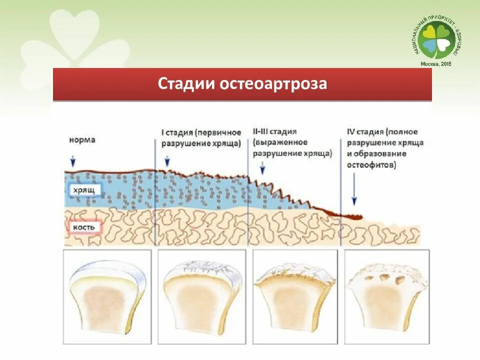 Явления остеоартроза. Классификация остеоартроза.