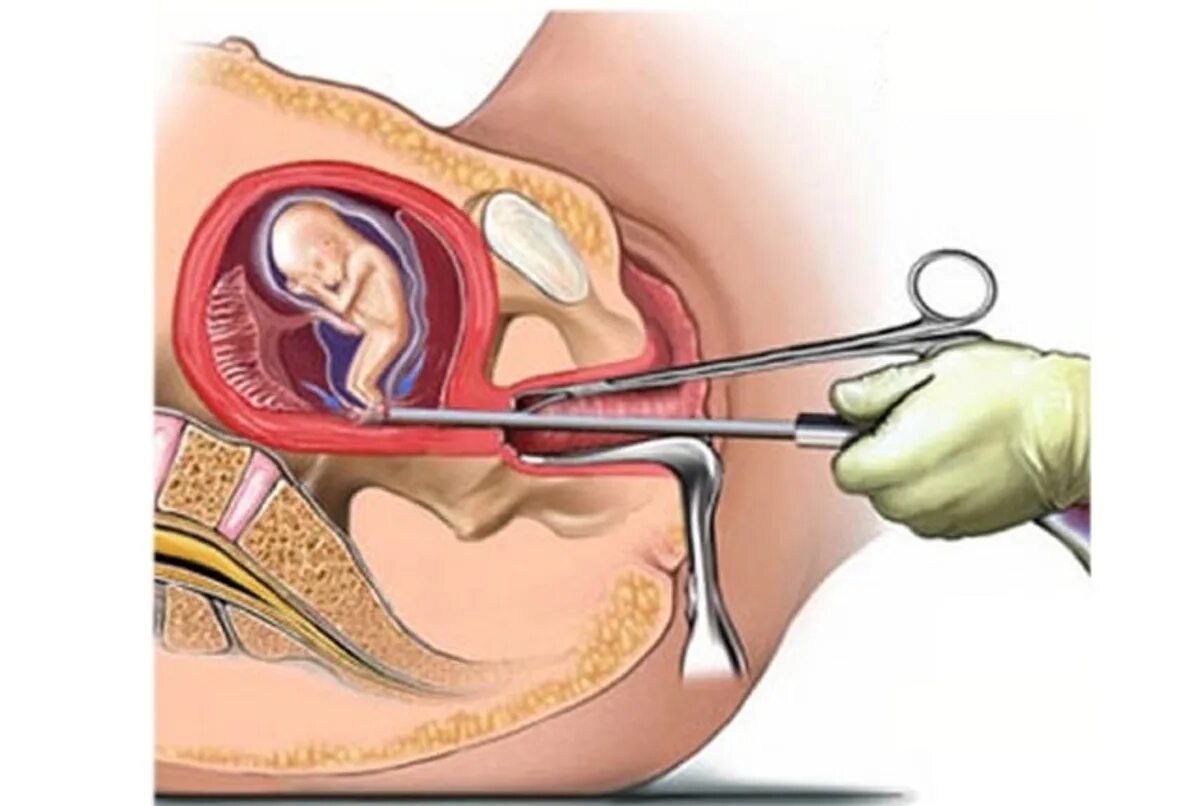 Выскабливание матки беременность. Хирургическое выскабливание полости матки. Выкидыш выскабливание матки. Выскабливание полости матки аборт. Инструментальное выскабливание полости матки аборт.