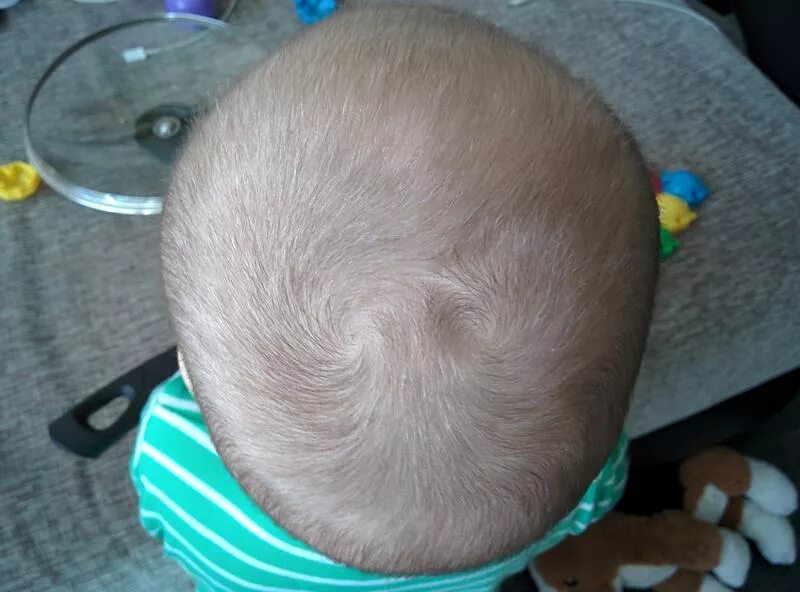 Две макушки на голове у ребенка. Волосы у новорожденных на голове. Затылочные Бугры на голове.