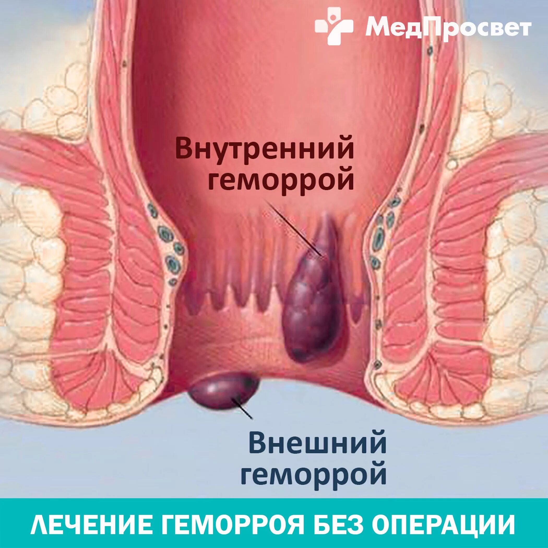 Сфинктерит прямой кишки симптомы