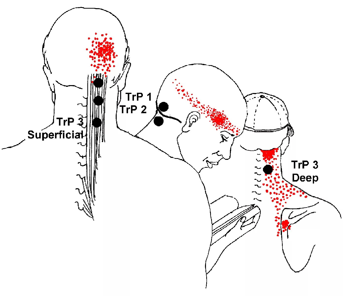 Точки на затылке. Головная боль триггерные точки. Миофасциальные боли триггерные точки. Миофасциальные триггерные точки головы. Триггерные точки мышц головы.
