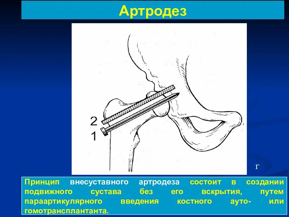 Артродез тазобедренного сустава. Операция артродеза тазобедренного сустава.. Внутрисуставной артродез. Артродез г/стопного сустава. Артродез суставов операция