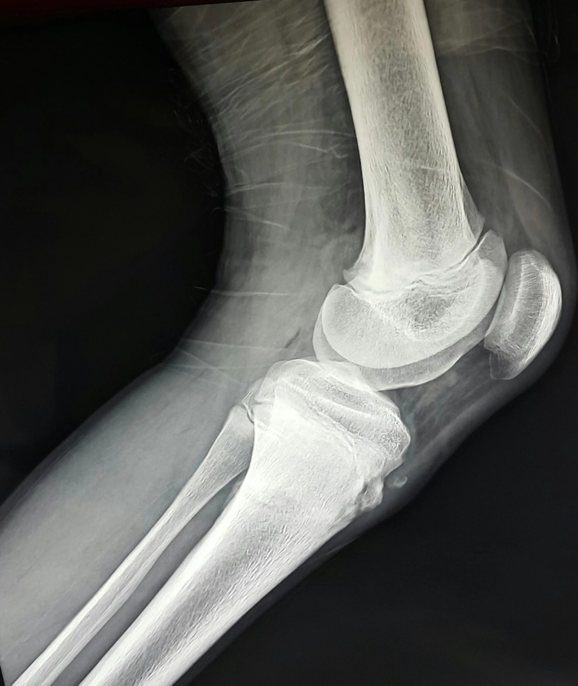 Fracture c