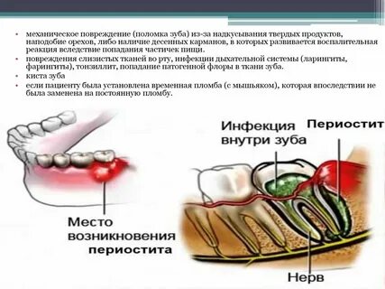 Периостит мкб