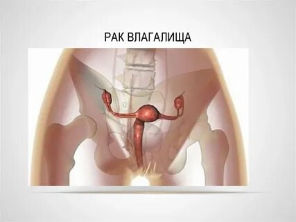 Можно ли нащупать кисту
