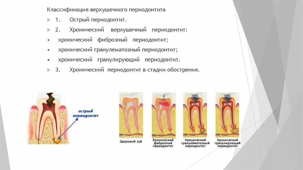 Фиброзный периодонтит. Хронический верхушечный гранулирующий периодонтит. Хронический апикальный периодонтит. Гнойный периодонтит классификация. Общую симптоматологию хронических форм периодонтита..