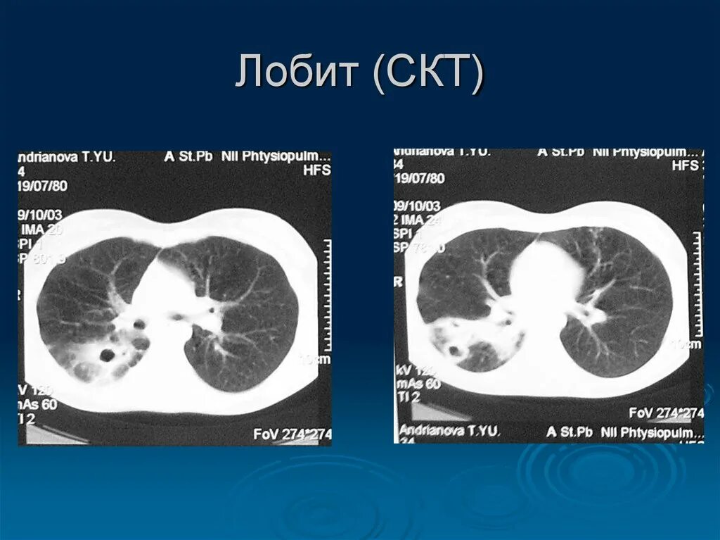 Лобить. Лобит инфильтративный туберкулез кт. СКТ СКТ.