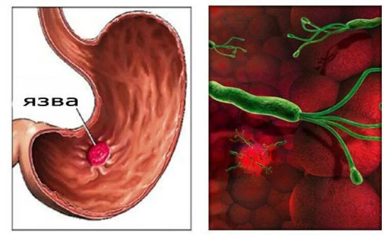 Язвенная болезнь желудка и язва желудка. Хронический гастрит язвенная болезнь желудка. Гастрит желудка и 12-перстной. Лечение язвы желудка у взрослых