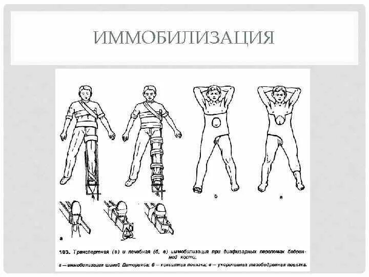 Ушиб тазобедренного сустава карта вызова. Иммобилизация тазобедренного сустава. иммобилизация при травме тазобедренного сустава. транспортная иммобилизация при переломе бедренной кости. иммобилизация при переломе бедренной кости.