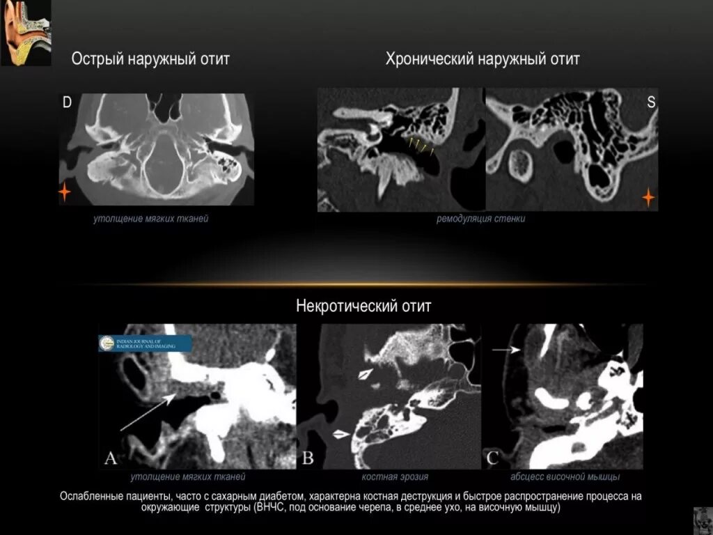 Кт анатомия сосцевидного отростка. Сосцевидный отросток височной кости кт. Пирамидка височной кости на кт. Отит кт височной кости. Утолщение слизистой сосцевидного отростка