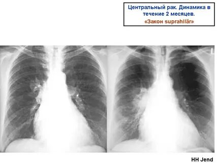 Рак легких прогноз