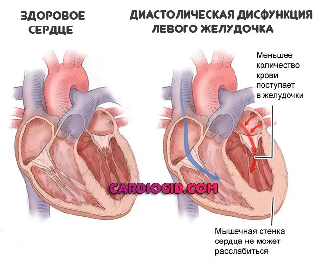 Нарушение диастолической функции левого желудочка по 1. Диастолическая дисфункция левого желудочка. Диастолическая дисфункция левого желудочка 1. Дисфункция миокарда левого желудочка. Нарушение диастолической функции левого желудочка.