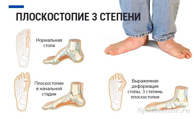 1 3 стопы. Плоскостопие 3 степени у детей. степени плоскостопия вид сбоку. плоскостопие стопы 4 степени. продольное плоскостопие 2-3 степени у детей.