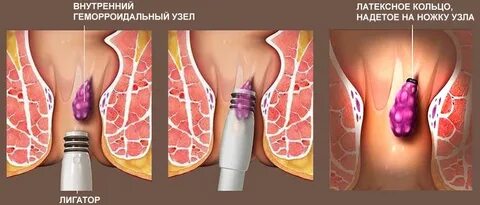 Лазерный операция геморрой сколько