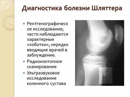 Синдром суставов у детей