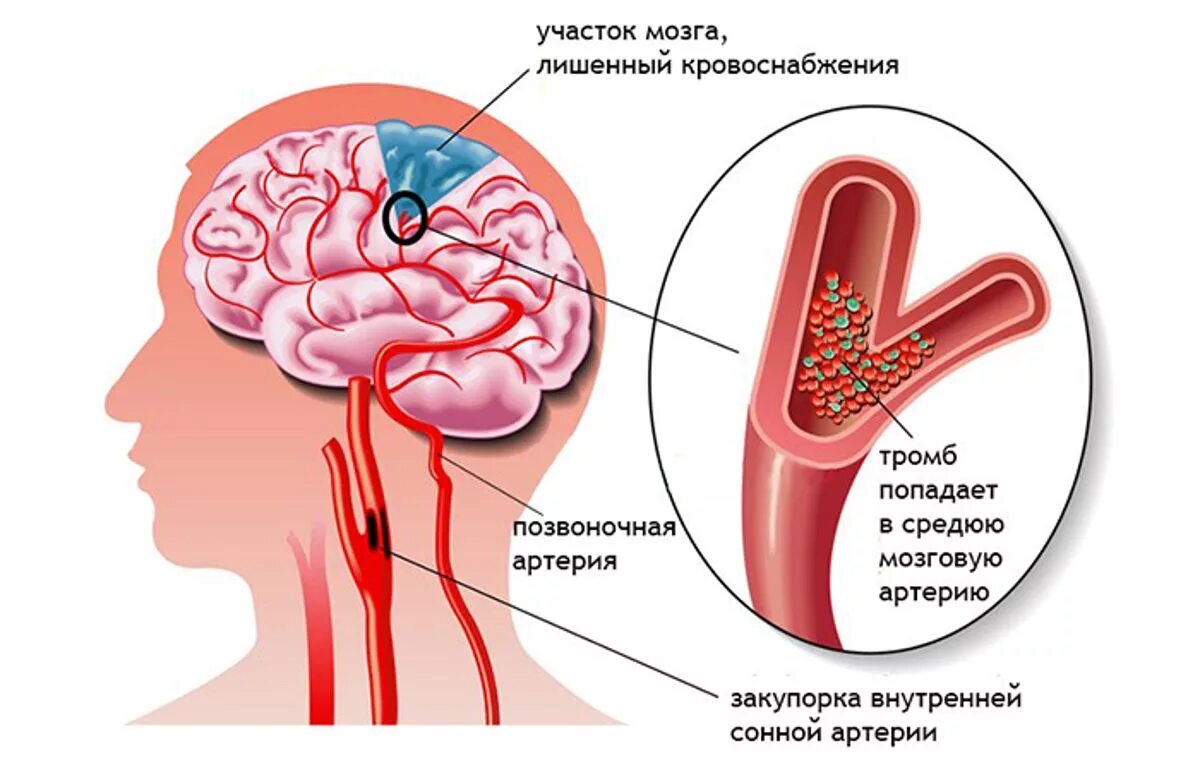 Зона инсульта. Ишемия ишемический инсульт мозга. Ишемия мозга 2 степени у новорожденных. Ишемический инсульт зоны поражения головного мозга. Ишемический инсульт головного мозга клиника.