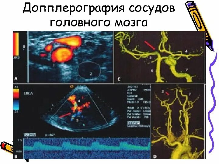 Транскраниальных артерий и вен. Транскраниальная ультразвуковая допплерография. УЗИ допплерография сосудов головного мозга. Транскраниальная допплерография (ТКДГ. Ультразвуковая допплерография экстракраниальных сосудов.