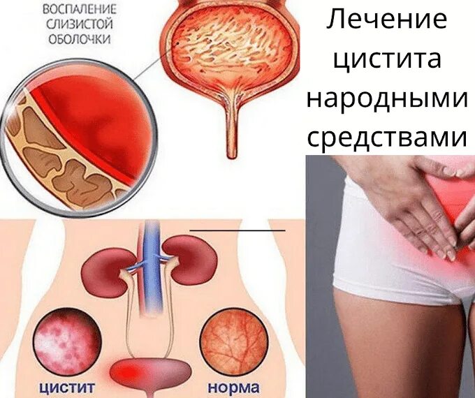 Срочная помощь при цистите