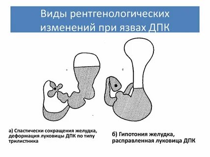 Деформация луковицы 12 перстной