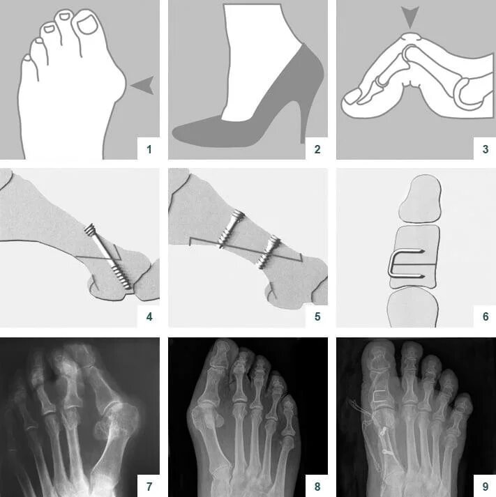 Остеотомия 1 плюсневой кости рентген. Вальгусная деформация пальца степени рентген деформация. Вальгус плюсневой кости. Рентген стопы халюс вальгус. Операция вальгусная реабилитация