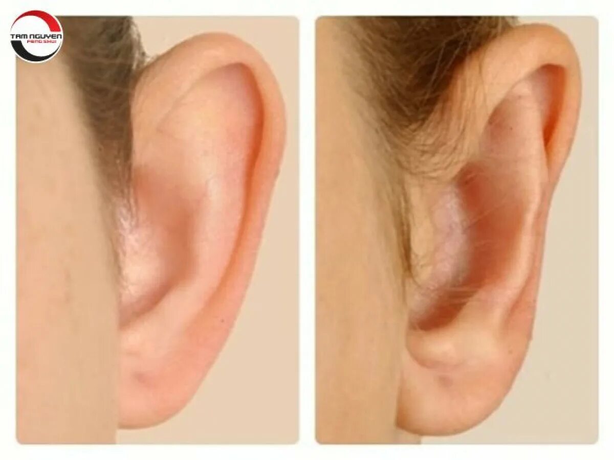 Мочка ушной раковины анатомия. Отопластика (1 ушная раковина). Как выглядит мочка уха. Как выглядит мочка уха. Как выглядит мочка уха.