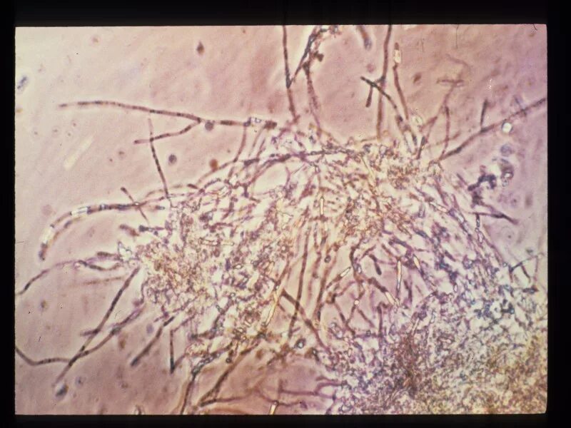 Грибы кандида микроскопия. Мицелий и псевдомицелий. Candida albicans микроскопия. На коже обнаружены споры
