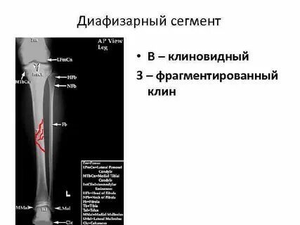 Код мкб перелом обеих костей голени
