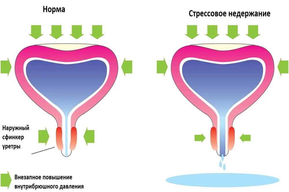 Ночные мочеиспускания у женщин пожилого возраста. Недержание мочи. Стрессовое недержание мочи. Профилактика недержания мочи. Недержание мочи картинки.