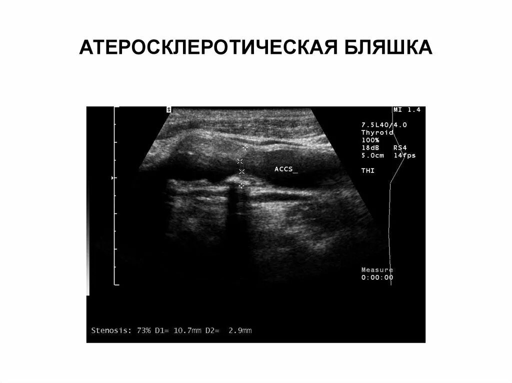 Атеросклеротическая бляшка узи. Нестабильная бляшка на узи\. нестабильная атеросклеротическая бляшка узи. гетерогенная атеросклеротическая бляшка.