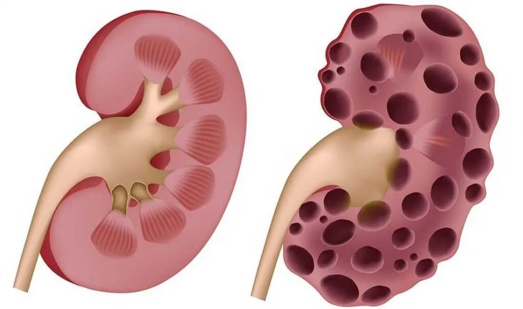 Алкоголь фактор риска. Органы здорового человека и алкоголика. Почка при хроническом пиелонефрите. Почка пьющего человека. Поликистоз почек клиническая картина.