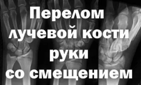 Перелом лучевой кости на сколько гипс