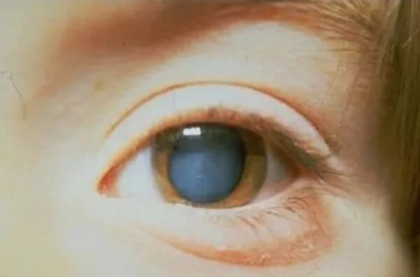 Заболевание куриная слепота витамины. Куриная слепота болезнь. Микрофтальм и катаракта.