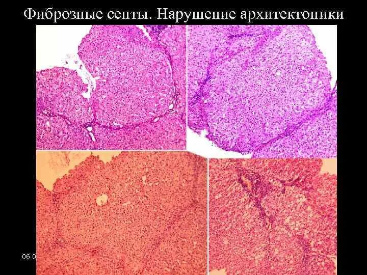 Нарушение архитектоники печени. Архитектоника печени. Фиброзные изменения печени